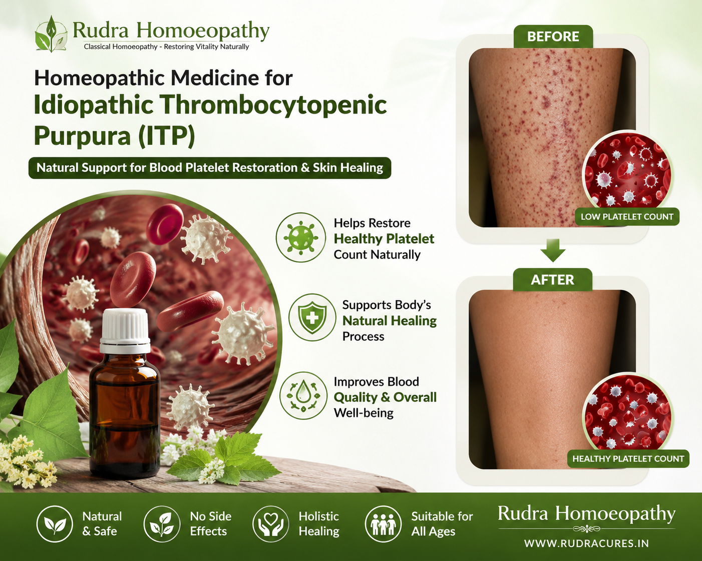 Homeopathic remedies for low platelet count, petechiae, purpura spots, nasal bleeding, and autoimmune blood care