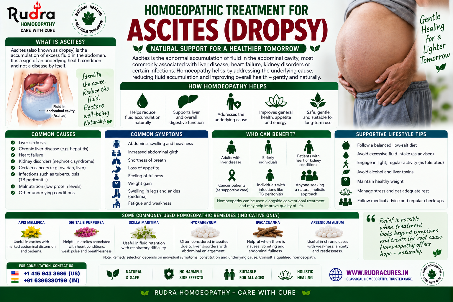 Homeopathic remedies for abdominal dropsy, portal hypertension, apocynum cannabinum, apis mellifica, and liver edema