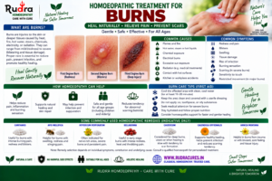 Homeopathic remedies for thermal scalds, second degree blister burns, cantharis vesicatoria, causticum, and urtica urens